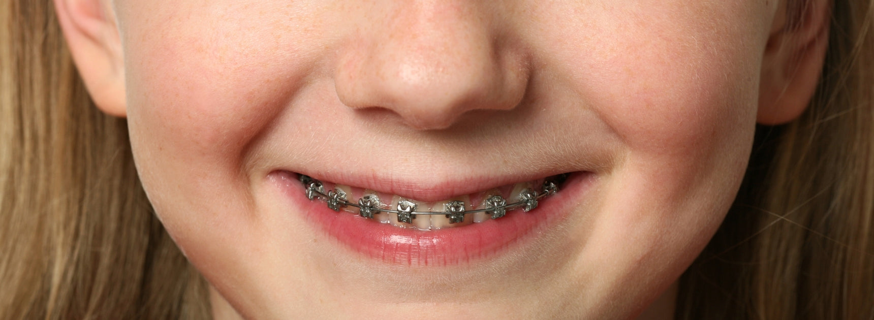 Kind trägt Zahnspange